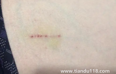 被貓抓了一下輕微破皮要打針嗎1