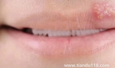 帶狀皰疹結(jié)痂后里面有膿咋辦3