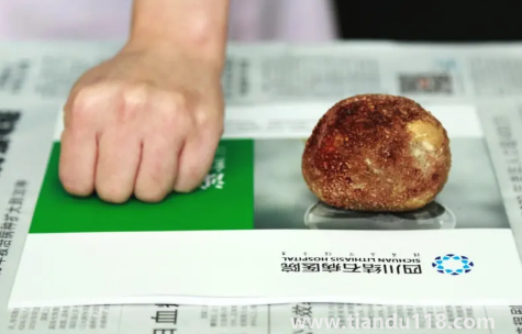 腎結(jié)石3mm需要治療嗎3