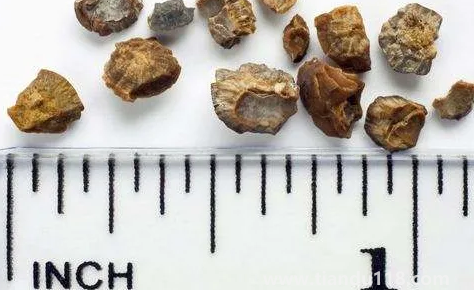 腎結(jié)石3mm需要治療嗎2