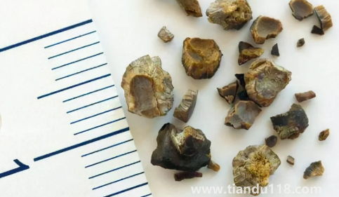 腎結石3mm×3mm多大（雙腎3×3mm小結石怎么辦）